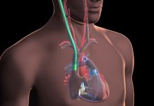 Minimally Invasive Cardiac Surgery: The Golden Age