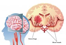 haemorrhagic stroke