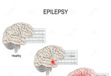 Epilepsy