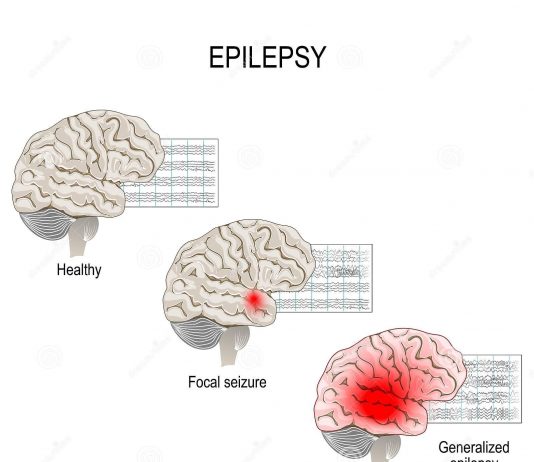 Epilepsy