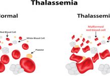 Thalassemia: It’s Preventable