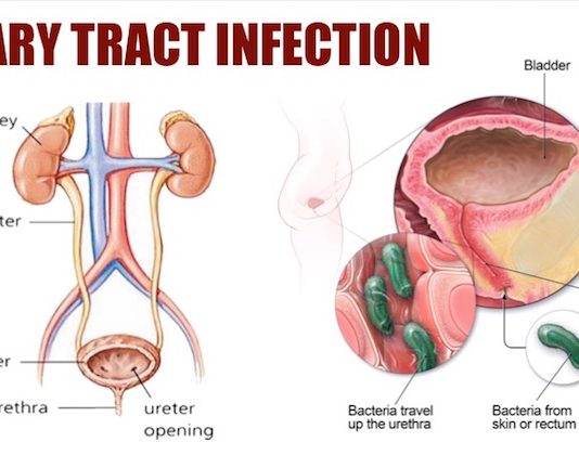 Urinary Tract Infections