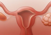 Poly Cystic Ovarian Disease (PCOD) Poly Cystic Ovarian Disease | Health Mantra Magazines