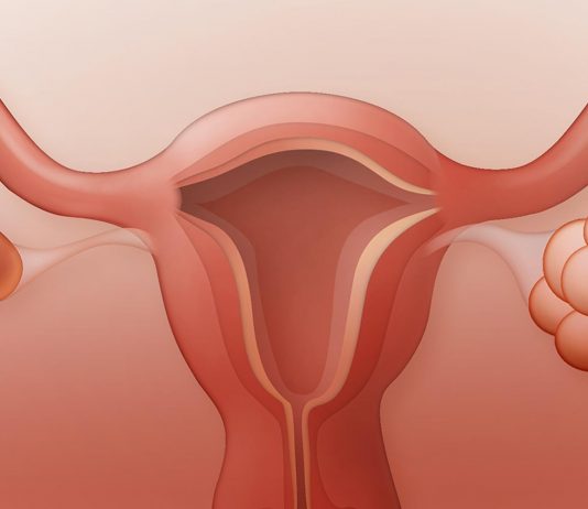 Poly Cystic Ovarian Disease (PCOD) Poly Cystic Ovarian Disease | Health Mantra Magazines