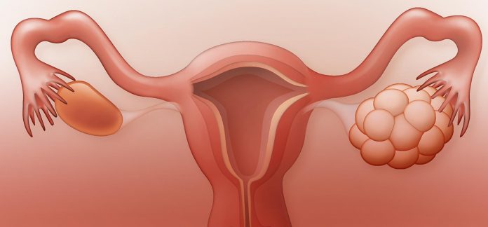 Poly Cystic Ovarian Disease | Health Mantra Magazines