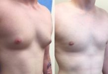 Gynecomastia : Feminine breasts on males can be really embarrassing Gynecomastia