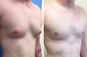 gynecomastia Gynecomastia