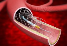 Angioplasty: Know the Procedure angioplasty