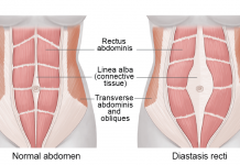 Mummy-tummy : Check for DR before you start gymming diastasis-recti