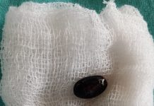 श्वांस नलिका में फंसा था सीताफल का बीज, बिना चीरफाड़ के निकाला ……. seethaphal