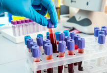 अब ब्लड टेस्ट से पता चल सकती है कोविड-19 संक्रमण की गंभीरता