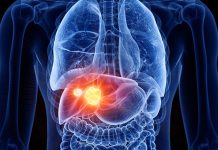 लीवर कैंसर को रोका जा सकता है Liver-Cancer
