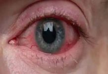 ब्लैक फंगस इन लोगों के लिए है ज्यादा घातक, चली जाती है आंखों की रोशनी