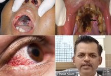 म्यूकॉरमाइकोसिस का एंटीबायोटिक्स या स्टेरॉयड्स से लेना देना नहीं Mucoramycosis