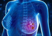 तेजी से फैल रहा महिलाओं में स्तन कैंसर, न करें नजरअंदाज, खुद ही करें पहचान