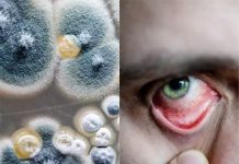 ब्लैक फंगस से ज़्यादा ख़तरनाक है वाइट फंगस, जानें इसके लक्षण और बचाव